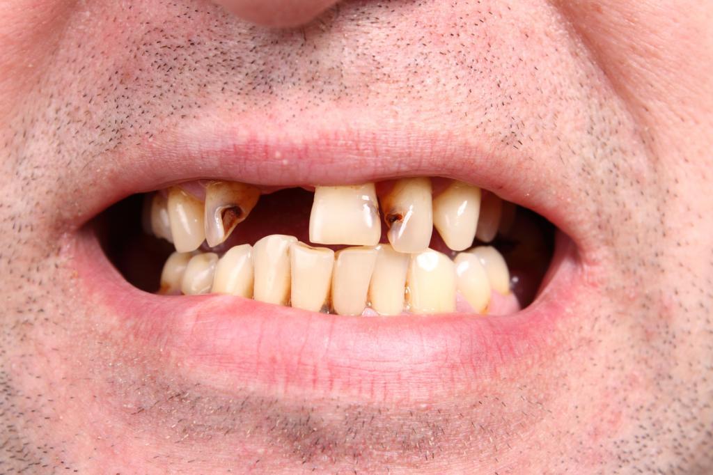 выпадение зубов